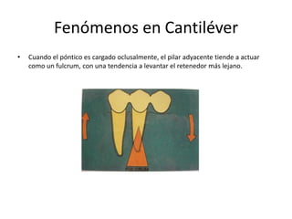 Fenómenos en Cantiléver
• Cuando el póntico es cargado oclusalmente, el pilar adyacente tiende a actuar
como un fulcrum, con una tendencia a levantar el retenedor más lejano.
 