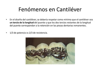 Fenómenos en Cantiléver
• En el diseño del cantiléver, se debería respetar como mínimo que el cantiléver sea
un tercio de la longitud del puente y que los dos tercios restantes de la longitud
del puente correspondan a la retención en las piezas dentarias remanentes.
• 1/3 de potencia vs 2/3 de resistencia.
 