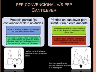 PFP CONVENCIONAL V/S PFP
CANTILEVER
Prótesis parcial fija
convencional de 3 unidades
La fuerza aplicada al póntico se distribuye
por igual a los dientes pilares.
Si existe un único póntico cerca del eje
que une los pilares, se aplica una menor
fuerza de palanca a los dientes pilares o a
los retenedores que con un Cantilever.
Póntico en cantilever para
sustituir un diente ausente
Las fuerzas aplicadas al póntico tienen un
efecto completamente diferente sobre el
diente pilar.
El póntico actúa como una palanca que
tiende a deprimirse bajo las fuerzas con
un vector oclusal fuerte
Las fuerzas aplicadas se
trasmiten a ambos dientes
pilares
Las fuerzas aplicadas
tiendes a inclinar la prótesis
o el diente pilar
 