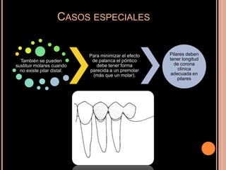 CASOS ESPECIALES
También se pueden
sustituir molares cuando
no existe pilar distal.
Para minimizar el efecto
de palanca el póntico
debe tener forma
parecida a un premolar
(más que un molar).
Pilares deben
tener longitud
de corona
clínica
adecuada en
pilares
 