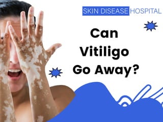 Can
Vitiligo
Go Away?
 