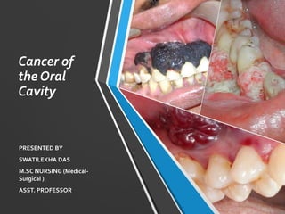 Cancer of
the Oral
Cavity
PRESENTED BY
SWATILEKHA DAS
M.SC NURSING (Medical-
Surgical )
ASST. PROFESSOR
 