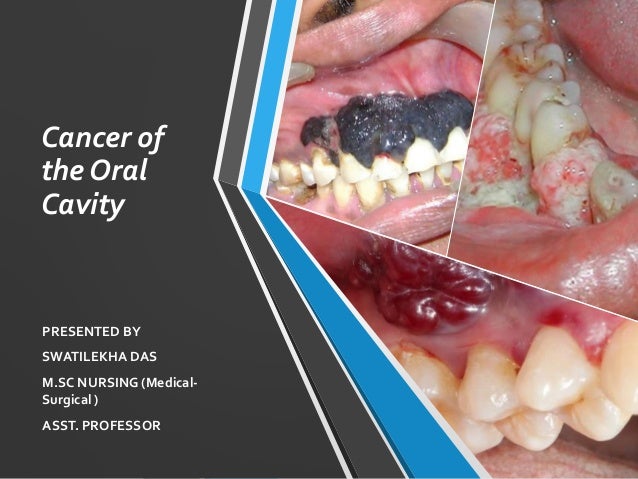 oral cavity cancer presentation