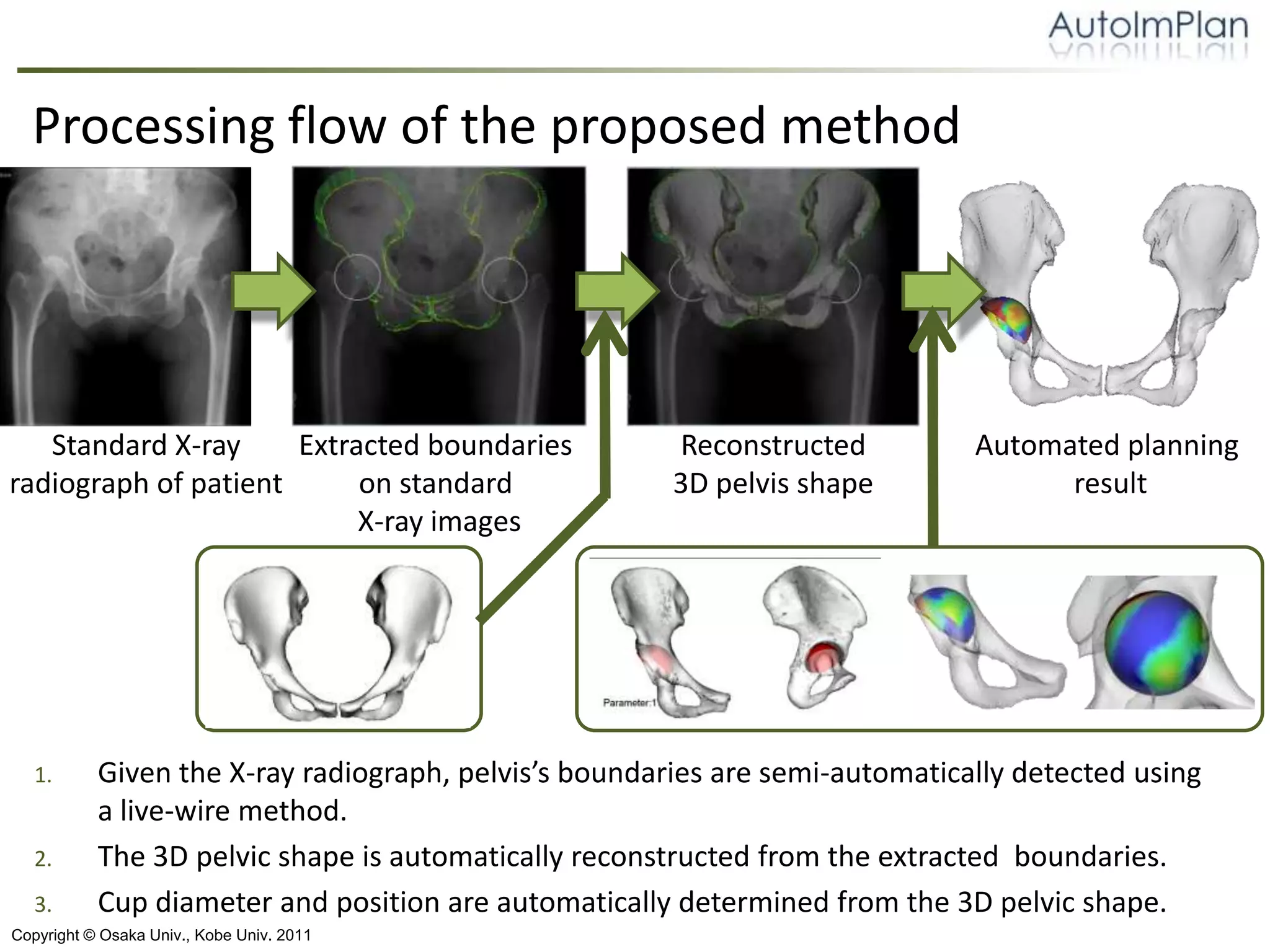 An automated 3D cup planning in total hip arthroplasty from a standard ...