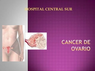 HOSPITAL CENTRAL SUR CANCER DE OVARIO 