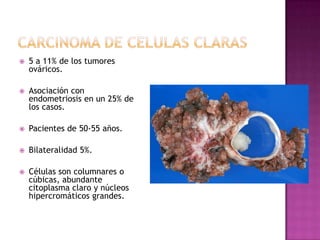CANCER DE OVARIO%DE TODASNEOPLASIASTIPO%BILATERAL ENDOMETRIOIDE.......................2040 TERATOMA.............................10BENIGNO(96%)MALIGNO (4%)........................115