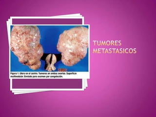 Presencia de ascitis. 2. DOPPLER COLOR.  Disminución de los índices de Resistencia IR < 0.40 y de Pulsatilidad IP < 0.80 en arterias ováricas. 