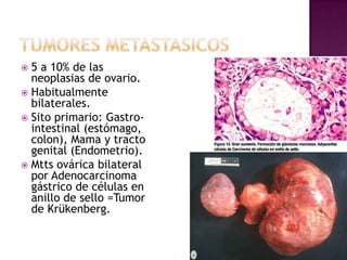 Vasos capsulares e intratumorales (septos y papilas) neoformados. 