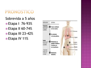 Factores predisponentes:Raza blanca.Edad sobre 40 años.Historia familiar de cáncer ovárico.Baja paridad.