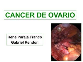 CANCER DE OVARIO
René Pareja Franco
Gabriel Rendón
 