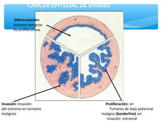 .
CANCER EPITELIAL DE OVARIO
Invasión: Invasión Proliferación: en
del estroma en tumores Tumores de bajo potencial
malignos maligno (borderline) sin
invasión estromal
Diferenciación:
lesiones benignas
no proliferativas
 