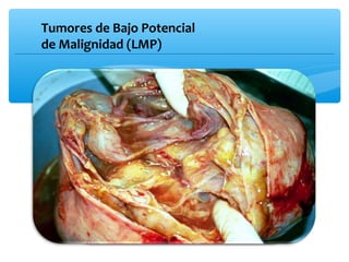 Tumores de Bajo Potencial
de Malignidad (LMP)
 