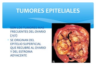 ∗ SON LOS TUMORES MAS
FRECUENTES DEL OVARIO
(75%)
∗ SE ORIGINAN DEL
EPITELIO SUPERFICIAL
QUE RECUBRE AL OVARIO
Y DEL ESTROMA
ADYACENTE
TUMORES EPITELIALES
 