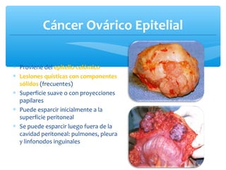 Cáncer Ovárico Epitelial
∗ Proviene del epitelio celómico
∗ Lesiones quísticas con componentes
sólidos (frecuentes)
∗ Superficie suave o con proyecciones
papilares
∗ Puede esparcir inicialmente a la
superficie peritoneal
∗ Se puede esparcir luego fuera de la
cavidad peritoneal: pulmones, pleura
y linfonodos inguinales
 