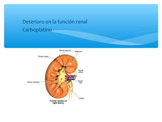 ∗ Deterioro en la función renal
∗ Carboplatino
 