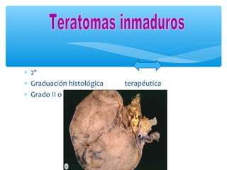 ∗ 2º
∗ Graduación histológica terapéutica
∗ Grado II o III  Quimioterapia
 