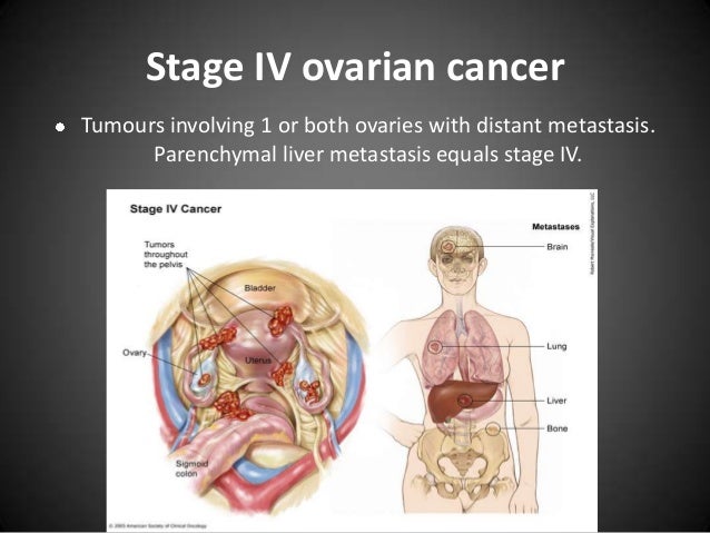 Ca ovary dr. varun