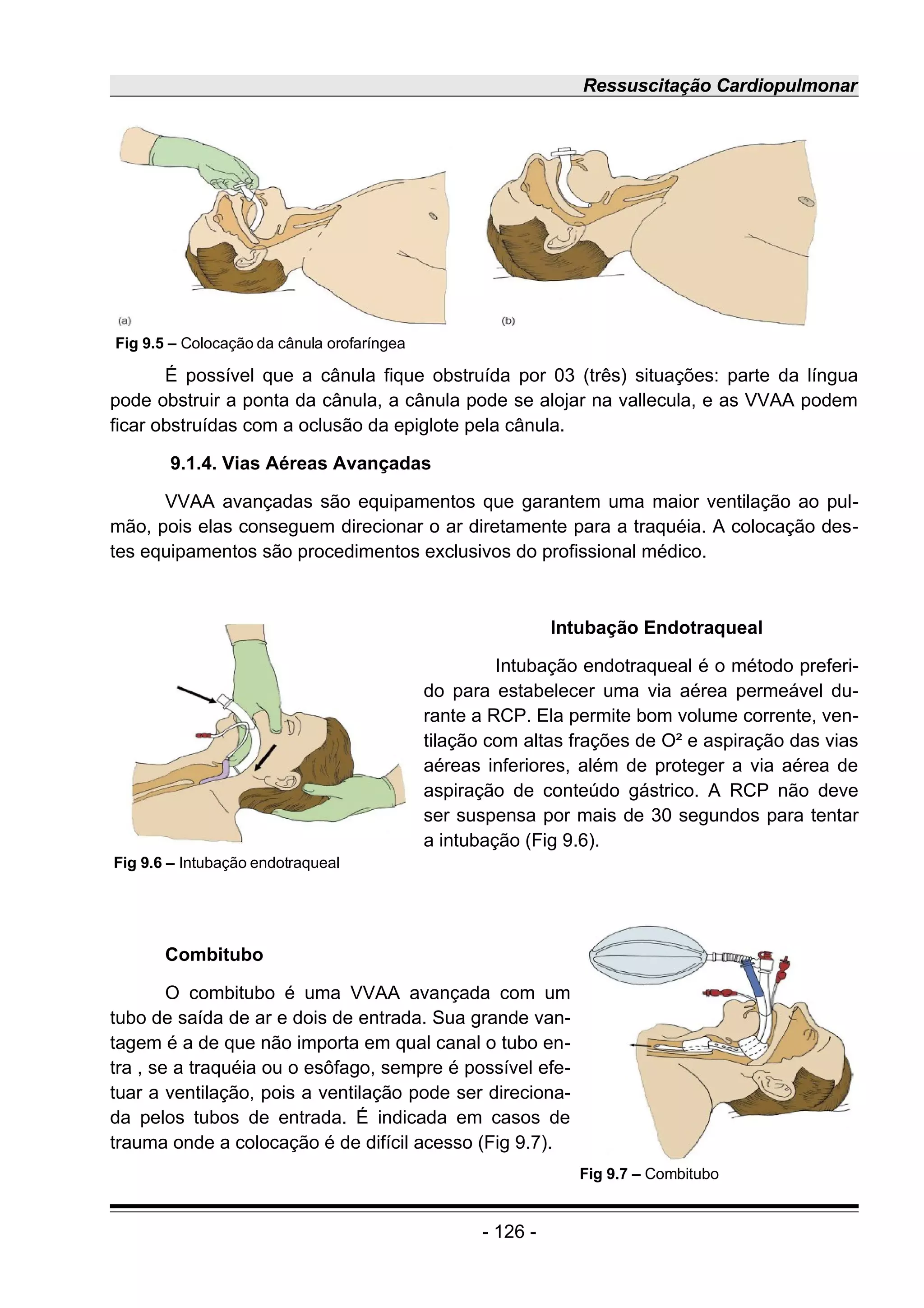 Ressuscitação Cardiopulmonar
É possível que a cânula fique obstruída por 03 (três) situações: parte da língua
pode obstruir a ponta da cânula, a cânula pode se alojar na vallecula, e as VVAA podem
ficar obstruídas com a oclusão da epiglote pela cânula.
9.1.4. Vias Aéreas Avançadas
VVAA avançadas são equipamentos que garantem uma maior ventilação ao pul-
mão, pois elas conseguem direcionar o ar diretamente para a traquéia. A colocação des-
tes equipamentos são procedimentos exclusivos do profissional médico.
Intubação Endotraqueal
Intubação endotraqueal é o método preferi-
do para estabelecer uma via aérea permeável du-
rante a RCP. Ela permite bom volume corrente, ven-
tilação com altas frações de O² e aspiração das vias
aéreas inferiores, além de proteger a via aérea de
aspiração de conteúdo gástrico. A RCP não deve
ser suspensa por mais de 30 segundos para tentar
a intubação (Fig 9.6).
Combitubo
O combitubo é uma VVAA avançada com um
tubo de saída de ar e dois de entrada. Sua grande van-
tagem é a de que não importa em qual canal o tubo en-
tra , se a traquéia ou o esôfago, sempre é possível efe-
tuar a ventilação, pois a ventilação pode ser direciona-
da pelos tubos de entrada. É indicada em casos de
trauma onde a colocação é de difícil acesso (Fig 9.7).
- 126 -
Fig 9.5 – Colocação da cânula orofaríngea
Fig 9.7 – Combitubo
Fig 9.6 – Intubação endotraqueal
 