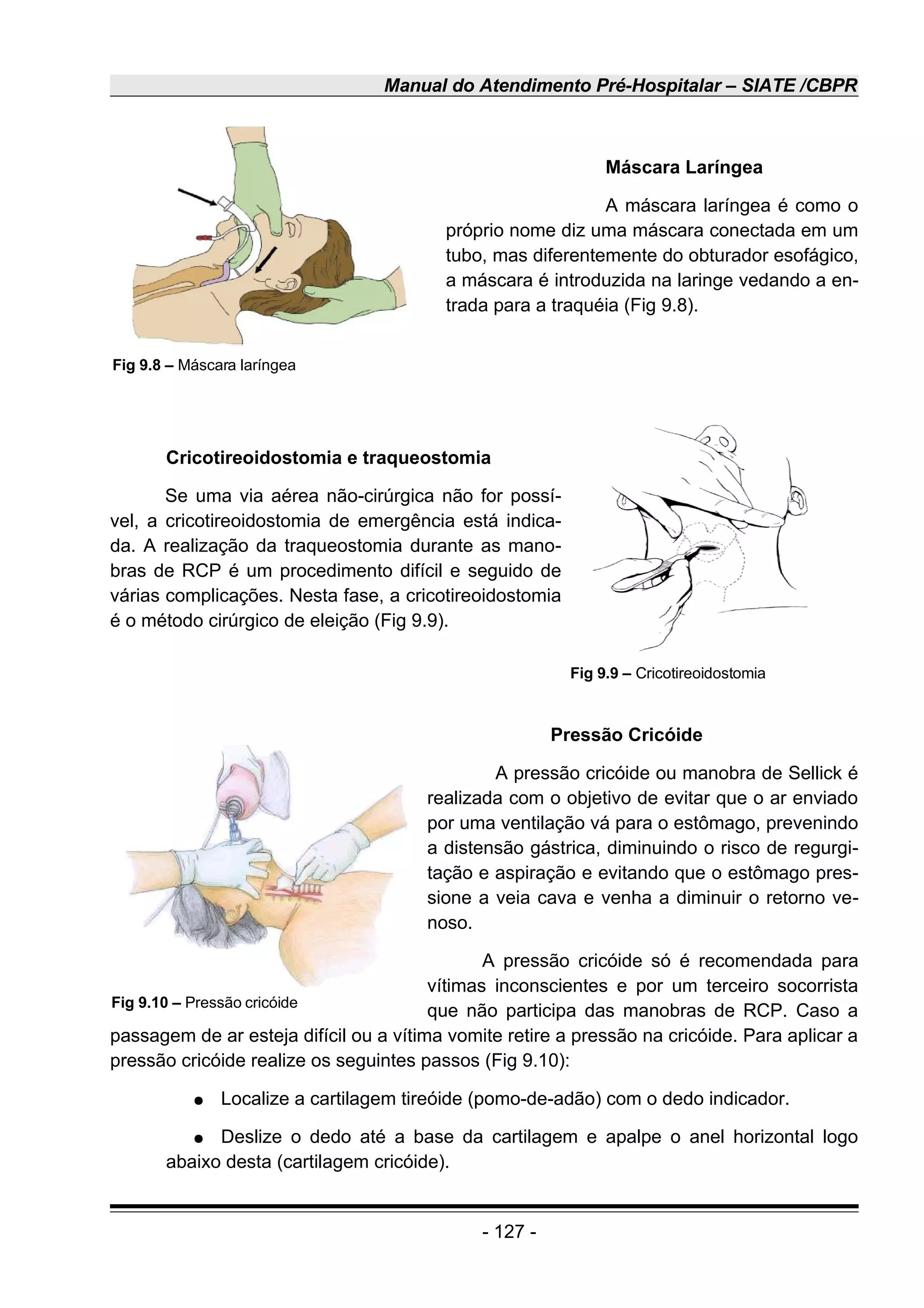 Manual do Atendimento Pré-Hospitalar – SIATE /CBPR
Máscara Laríngea
A máscara laríngea é como o
próprio nome diz uma máscara conectada em um
tubo, mas diferentemente do obturador esofágico,
a máscara é introduzida na laringe vedando a en-
trada para a traquéia (Fig 9.8).
Cricotireoidostomia e traqueostomia
Se uma via aérea não-cirúrgica não for possí-
vel, a cricotireoidostomia de emergência está indica-
da. A realização da traqueostomia durante as mano-
bras de RCP é um procedimento difícil e seguido de
várias complicações. Nesta fase, a cricotireoidostomia
é o método cirúrgico de eleição (Fig 9.9).
Pressão Cricóide
A pressão cricóide ou manobra de Sellick é
realizada com o objetivo de evitar que o ar enviado
por uma ventilação vá para o estômago, prevenindo
a distensão gástrica, diminuindo o risco de regurgi-
tação e aspiração e evitando que o estômago pres-
sione a veia cava e venha a diminuir o retorno ve-
noso.
A pressão cricóide só é recomendada para
vítimas inconscientes e por um terceiro socorrista
que não participa das manobras de RCP. Caso a
passagem de ar esteja difícil ou a vítima vomite retire a pressão na cricóide. Para aplicar a
pressão cricóide realize os seguintes passos (Fig 9.10):
● Localize a cartilagem tireóide (pomo-de-adão) com o dedo indicador.
● Deslize o dedo até a base da cartilagem e apalpe o anel horizontal logo
abaixo desta (cartilagem cricóide).
- 127 -
Fig 9.8 – Máscara laríngea
Fig 9.9 – Cricotireoidostomia
Fig 9.10 – Pressão cricóide
 