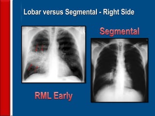 26 
Lobar versus Segmental - Right Side  