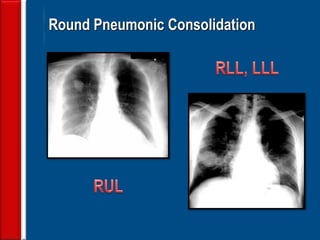 29 Round Pneumonic Consolidation  
