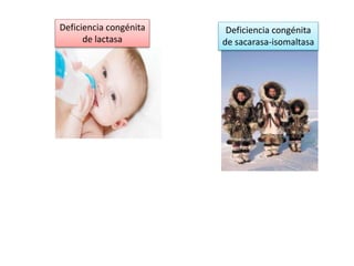 Deficiencia congénita
de lactasa
Deficiencia congénita
de sacarasa-isomaltasa
 