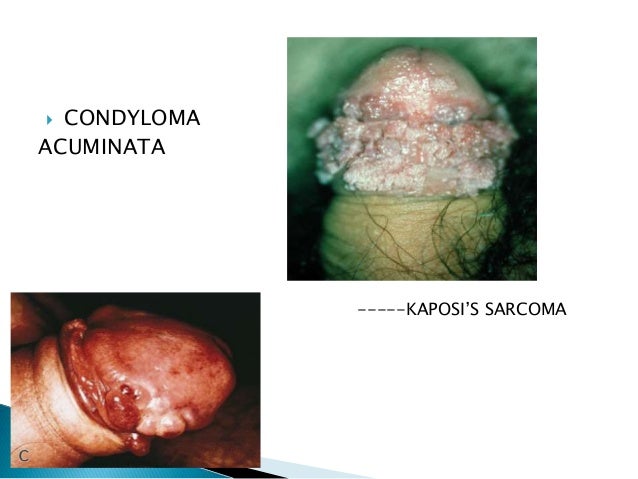 DermIS - Condyloma Acuminatum (information on the diagnosis)