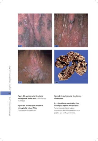 28
Figura 2.8. Vulvoscopia, Neoplasia
intraepitelial vulvar (NIV). Distribución
mul focal.
Figura 2.9. Vulvoscopia, Neopla...