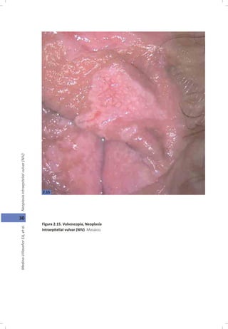 30
Figura 2.15. Vulvoscopia, Neoplasia
intraepitelial vulvar (NIV). Mosaico.
2.15
 