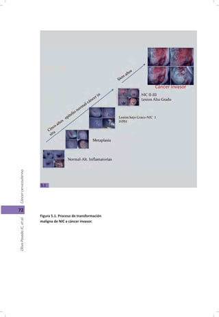 Cáncer cérvicouterino