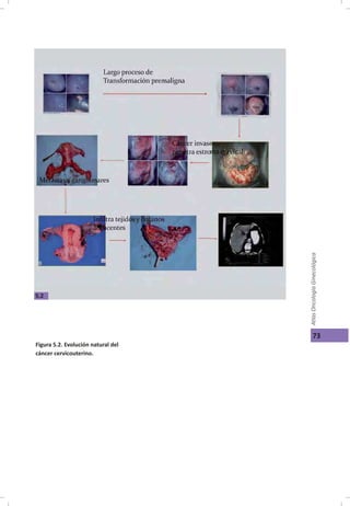 Cáncer cérvicouterino