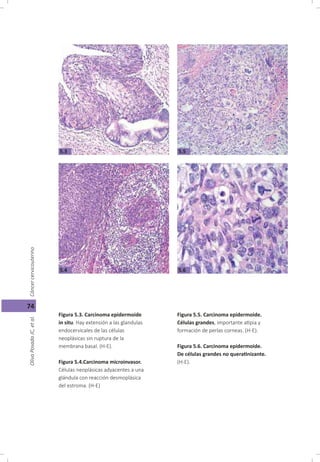 Cáncer cérvicouterino