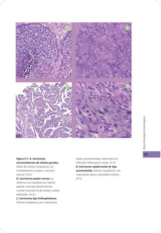 Cáncer cérvicouterino