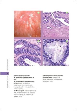 Cáncer cérvicouterino