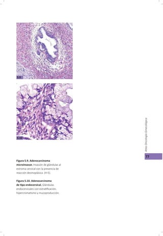 Cáncer cérvicouterino