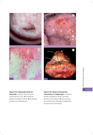 Cáncer cérvicouterino