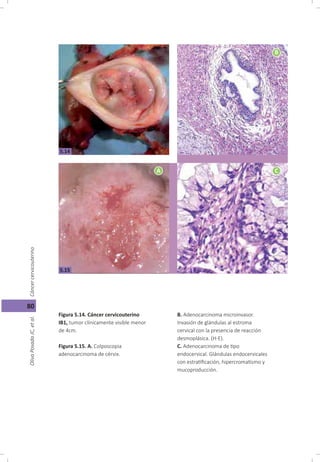 Cáncer cérvicouterino