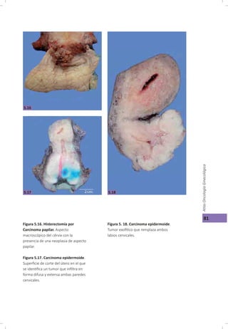 Cáncer cérvicouterino