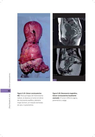 Cáncer cérvicouterino