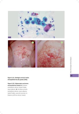 Cáncer cérvicouterino