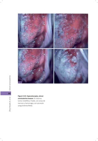 Cáncer cérvicouterino