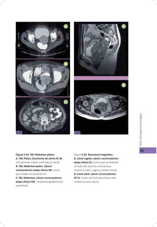 Cáncer cérvicouterino