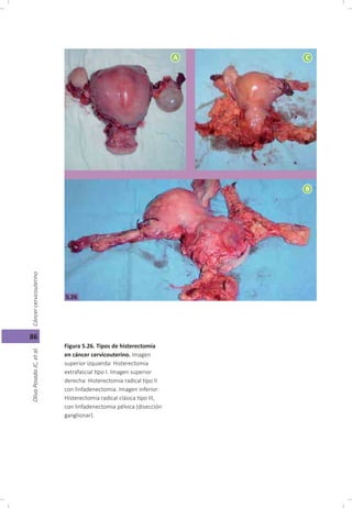 Cáncer cérvicouterino