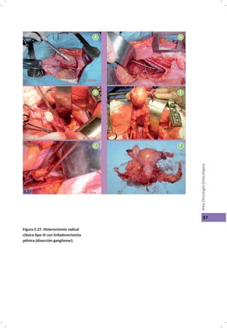 Cáncer cérvicouterino