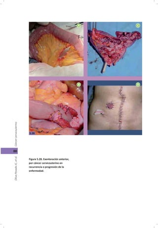 Cáncer cérvicouterino