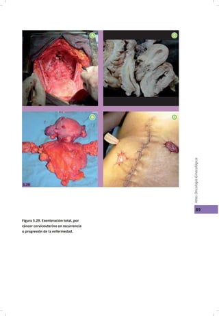 Cáncer cérvicouterino