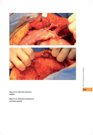 161
Figura 11.2. Extensión tumoral a
epiplón.
Figura 11.3. Implantes tumorales en
peritoneo parietal.
11.2
11.3
 