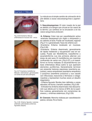 29
Apartado 2: Mácula
La mácula es el simple cambio de coloración de la
piel debido a causa vasculosanguínea o pigmen-
taria.
1- Vasculosanguínea: El color rosado de la piel
es debido a la sangre que circula en los vasos de
la dermis. Los cambios en la circulación o en los
vasos sanguíneos producen:
A- Eritema: Color rojo por vasodilatación activa
arteriolar. Desaparece por dígito o vitropresión y
es caliente al tacto. Puede ser localizado, regional
(Fig.2-1) o generalizado.Tipos de eritema son:
-Enantema: Eritema localizado en mucosas.
(Fig.2-26)
-Exantema: Eritema diseminado, generalmente
de rápida instalación y recuperación casi sin se-
cuelas. Puede ser: Morbiliforme, roseoliforme o
escarlatiniforme. Los dos primeros alternan con
áreas de piel sana. El morbiliforme con manchas
confluentes de varios mm. (Fig.2-27) y el roseoli-
forme en forma moteada. El escarlatiniforme con
base eritematosa difusa sobre la que aparecen
elementos puntiformes. Generalmente terminan
por presentar lesiones papulosas (exantema pa-
puloso),vesico-ampollosas (exantema ampolloso)
o purpúrico (exantema purpúrico) y sus causas
son infecciosas, reacciones a fármacos o colage-
nopatías y representan muchas veces un desafío
diagnóstico.
- Eritema figurado: Bordes bien definidos, a veces
elevados, de forma y tamaño variables. (Fig.2-28)
- Eritrodermia:Eritema diseminado más descama-
ción que afecta por lo menos el 90% de la super-
ficie cutánea, generalmente con compromiso de
anexos y síntomas sistémicos. (Fig.2-29)
B- Cianosis: Mancha violácea por vasodilatación
pasiva, venosa, fría al tacto.
Fig. 2-26: Enantema. Mácula
eritematosa en mucosa oral – encía.
Fig. 2-27: Exantema morbiliforme
Máculas eritematosas generalizadas
con áreas de piel sana (Dengue)
Fig. 2-28: Eritema figurado. Lesiones
eritemato- edematosas arciformes
figuradas (Sepsis)
 