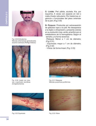 30
CAPITULO
2
C- Lívido: Piel pálida, azulada, fría, por
isquemia. A veces con aspecto en red o
malla (lívedo reticularis). Por trastornos or-
gánicos o funcionales del plexo arteriolar
de la piel. (Fig.2-30)
D- Púrpura: Producida por extravasación
de glóbulos rojos a la piel. No desaparece
a la dígito o vitropresión y presenta colores
en su evolución (rojo,verde,amarillo) por el
metabolismo de la hemoglobina. Según el
tamaño y la forma tenemos:
-Petequia: Menor a 1 cm de diámetro.
(Fig.2-31)
- Equímosis: mayor a 1 cm de diámetro.
(Fig.2-32)
- Víbice: de forma lineal. (Fig. 2-33)
Fig. 2-29: Eritrodermia
Máculas eritematosas generalizadas
escamo-costrosas (Penfigo foliáceo)
Fig. 2-31: Petequias
Máculas purpúricas puntiformes.
Fig. 2-32: Equimosis
Fig. 2-30: Livedo con úlce-
ras y equímosis necróticas
(Crioglobulinemia)
Fig. 2-33:Víbice
 