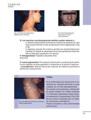 31
C A M B I A R
FOTO
E- Las manchas vasculosanguíneas también pueden deberse a:
a- Mancha angiomatosa:Aumento de números de capilares en cuyo
caso es permanente,el color se atenúa por fuerte dígitopresión.(Fig.
2-34)
b- Agenesia vascular: En la piel se percibe una mancha blanca per-
manente.Al realizar la vitropresión de la zona perilesional, ésta tam-
bién se blanquea, igualando a la mancha.
F- Telangiectasias: Trayectos vasculares finos.
(Fig.2-35)
2- Lesión pigmentaria: Por ausencia,disminución o aumento de la melani-
na; por depósito de otros pigmentos o sustancias en la dermis. Puede ser:
- Leucodérmica: Mancha blanca por ausencia de melanina (acrómica) o
disminución (hipocrómica).
Fig. 2-34: Mancha angiomatosa
(Malformación vascular)
Fig. 2-35:Telangiectasias
numerosas en rostro
(Esclerodermia)
Vitíligo
Es la enfermedad que típicamente se ca-
racteriza por máculas acrómicas, a veces
rodeada por un halo hiperpigmentado.
De acuerdo a la localización y distribución
se puede clasificar en: Vitíligo localizado
(1-2 lesiones), segmentario (sigue trayec-
to metamérico) o generalizado. (Fig.2-36)
No se conoce la etiología pero se detec-
tan anticuerpos antimelanina.
Puede acompañar a otras enfermedades
autoinmunes.
Fig. 2-36: Máculas acrómicas zoniformes
(Vitíligo segmentario)
 